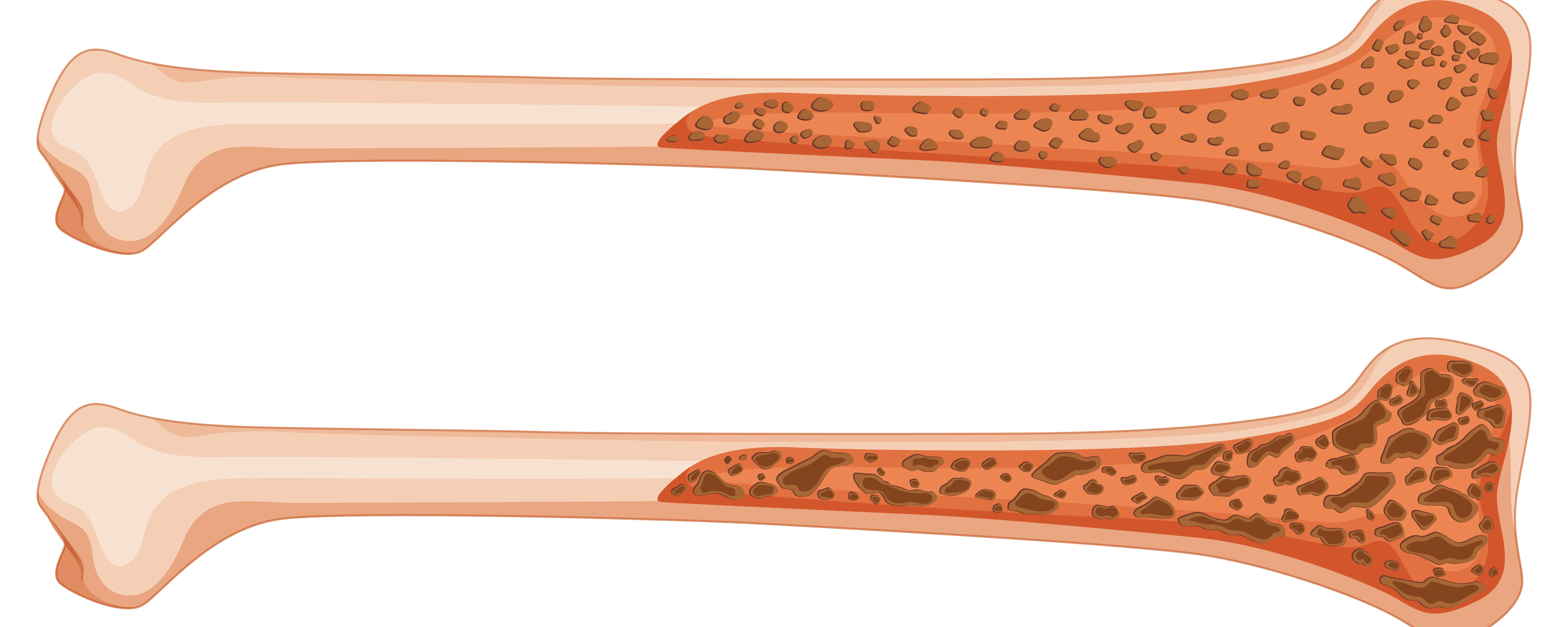 Новый состав костного цемента с антибиотиком решает проблему послеоперационных инфекционных осложнений - Клиника "DE-Clinic"